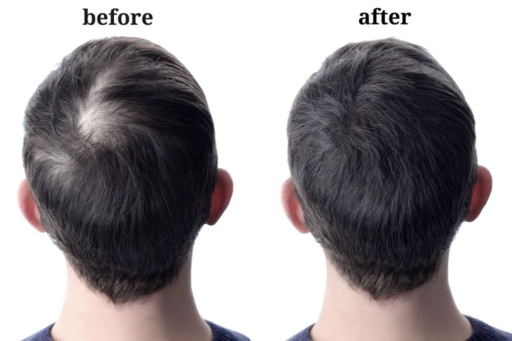 Can hair grow back after balding naturally
