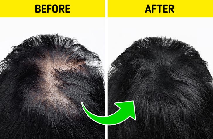 How to stop balding and regrow hair