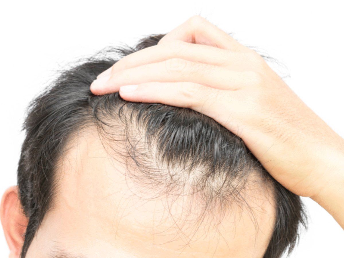 Is it possible to regrow hair on bald spot